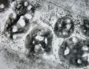 F,25y. | metachromatic leukodystrophy - n.suralis F,25y. | metachromatic leukodystrophy - n.suralis